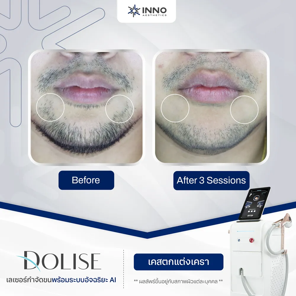 ผลลัพธ์หลังทำ "Dolise" Diode Laser