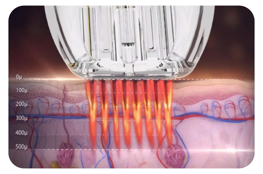 RF และ Microneedle Therapy ทำงานร่วมกันอย่างไรในระดับชั้นผิว