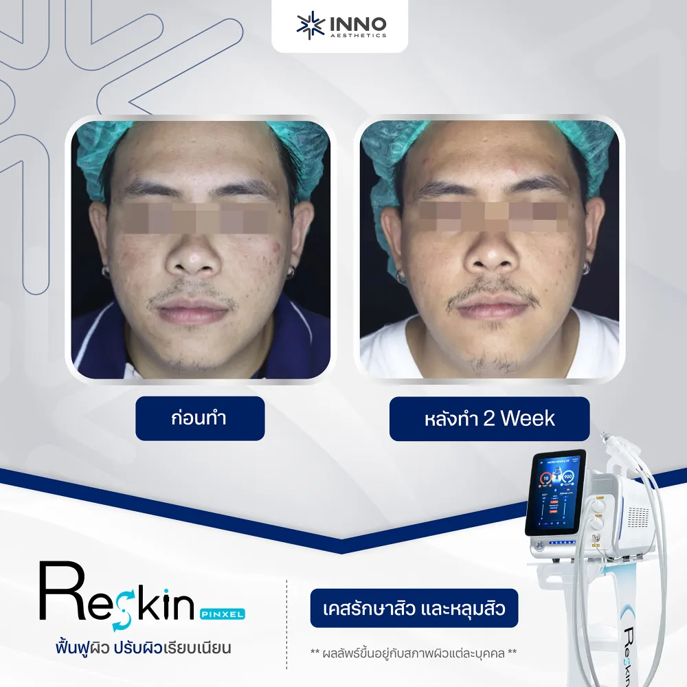 ทำไม RF Microneedle Therapy ถึงให้ผลลัพธ์ชัดกว่า