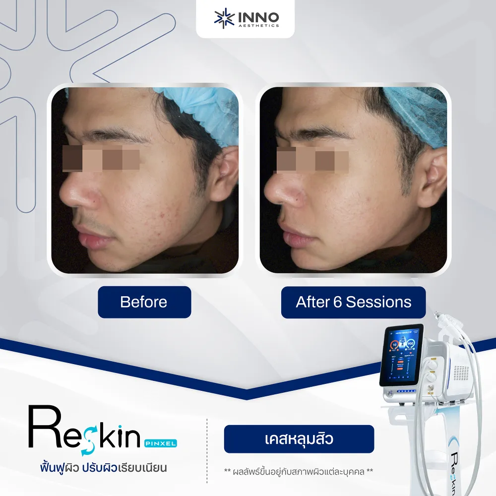 ทำไม RF Microneedle Therapy ถึงให้ผลลัพธ์ชัดกว่า
