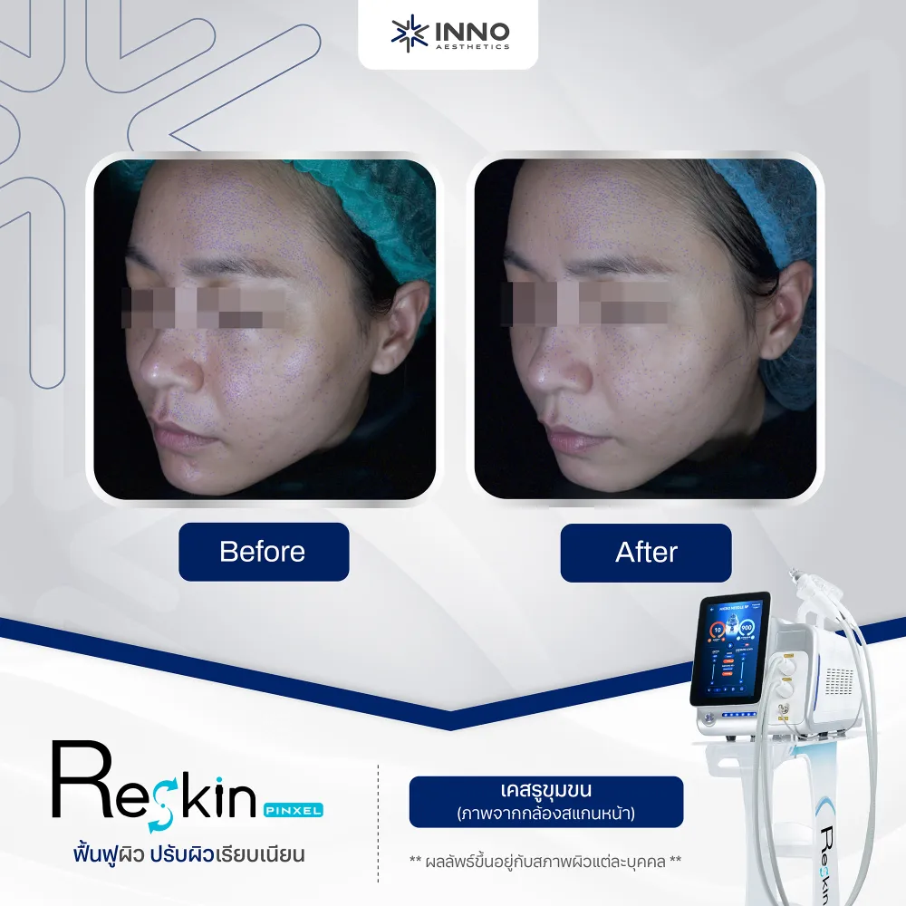 ทำไม RF Microneedle Therapy ถึงให้ผลลัพธ์ชัดกว่า