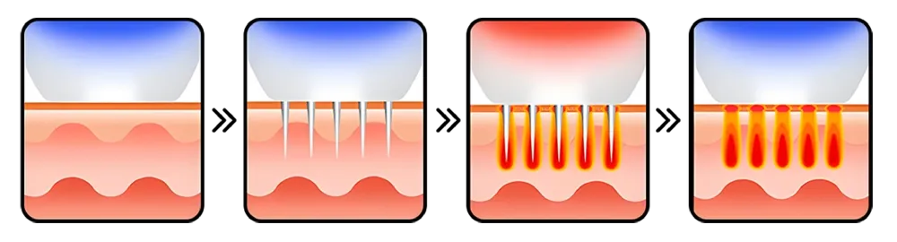 RF Microneedle Therapy ช่วยฟื้นฟูผิวได้อย่างไร