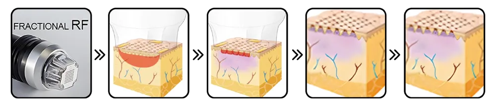 "Reskin Pinxel" เทคโนโลยี Micro needle + RF เพื่อผิวที่เรียบเนียน
