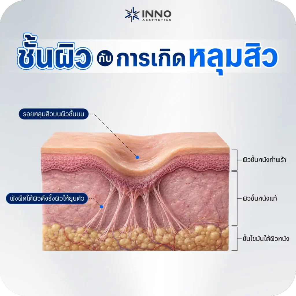 ชั้นผิวกับการเกิดหลุมสิว