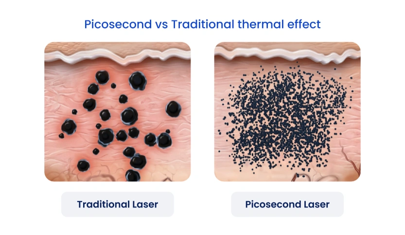 Picosecond vs Traditional thermal effect