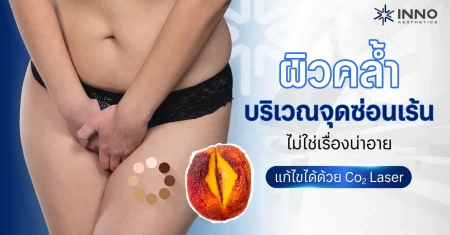 ผิวคล้ำบริเวณจุดซ่อนเร้น ไม่ใช่เรื่องน่าอาย แก้ไขได้ด้วย Co2 Laser