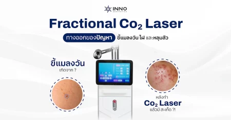fractional-co2-laser-mole-removal-cover-INNO-IMG Fractional Co2 Laser ทางออกของปัญหาขี้แมลงวัน ไฝ และหลุมสิว