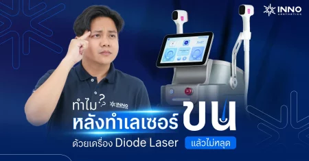 ทำไมหลังทำเลเซอร์ขนด้วย เครื่อง Diode Laser แล้วขนไม่หลุด