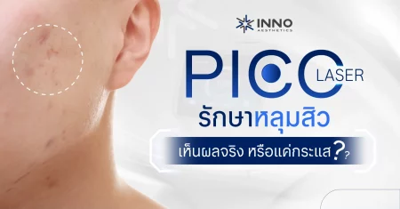 pico-laser-acne-scar-cover Pico Laser รักษาหลุมสิว เห็นผลจริงหรือแค่กระแส?